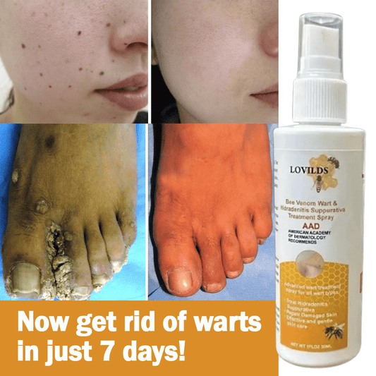 SS Bee Venom Wart Remover Spray (100% Original)