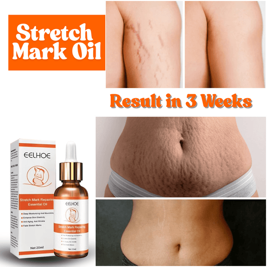 SC 🌿 SHO Doctor's Approved Stretch Mark Oil – Visible results in just 14 Days🌿