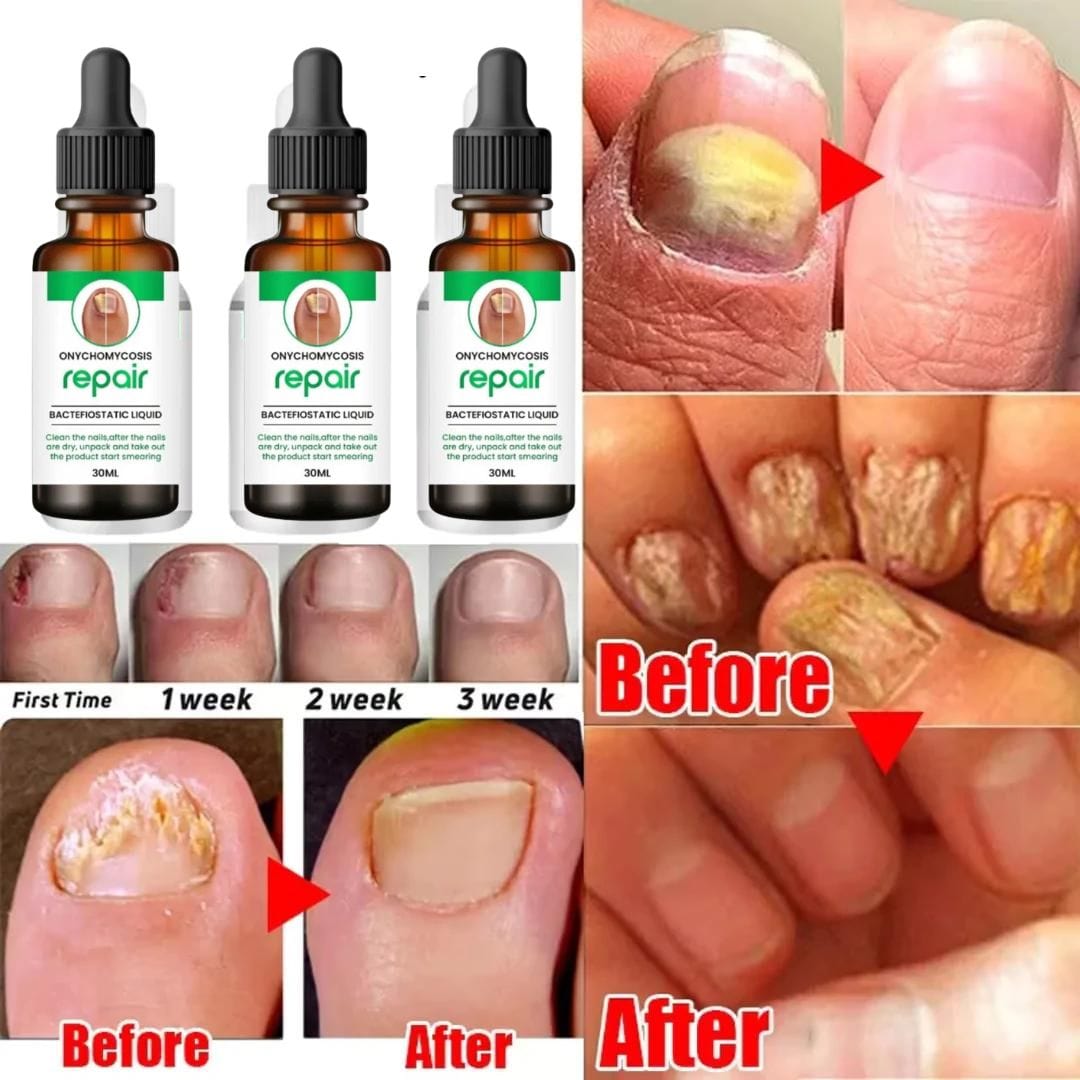 SS All In One Nail Serum 🔥 All Doctors 1st Choice 🔥(Buy 1 Get 1 Free)