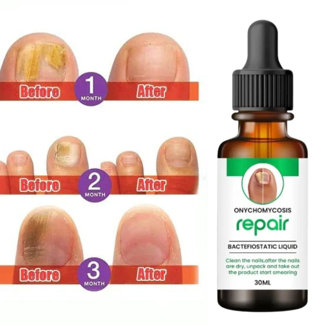 SS All In One Nail Serum 🔥 All Doctors 1st Choice 🔥(Buy 1 Get 1 Free)