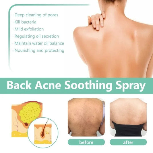 SHO Back Acne Spray – Easy, Effective, Acne-Free 🌿