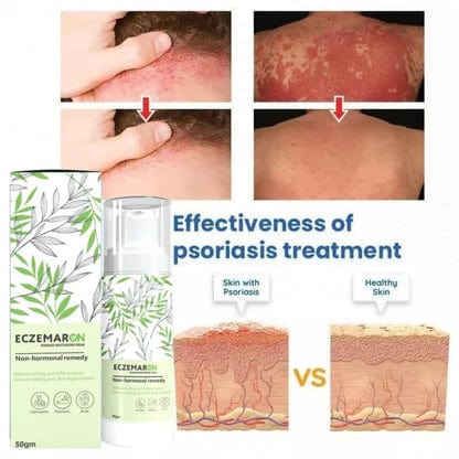 Ecze+ Anti Fungal Spray - Doctor's Recommended 👨🏽‍⚕️ Buy 1 Get 1 Free