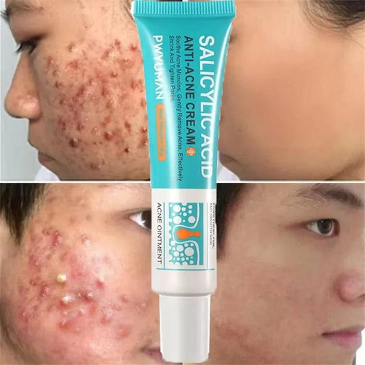 SC SHO Acne-Free Glow: Salicylic Acid Anti-Acne Cream - Results in 7 days 💧