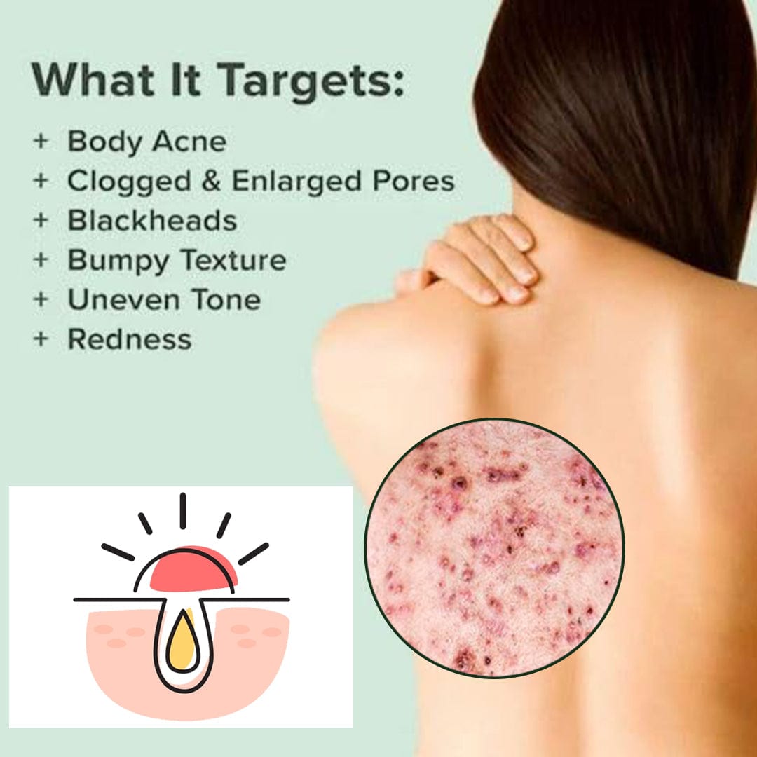 SC SHO Back Acne Spray – Easy, Effective, Acne-Free 🌿