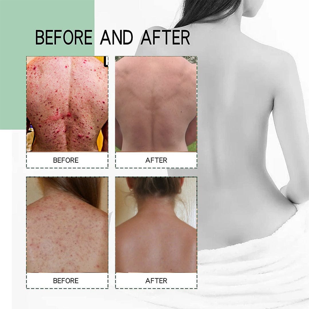 SC SHO Back Acne Spray – Easy, Effective, Acne-Free 🌿