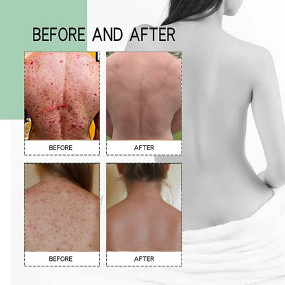 SC SHO Back Acne Spray – Easy, Effective, Acne-Free 🌿