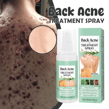 SC SHO Back Acne Spray – Easy, Effective, Acne-Free 🌿