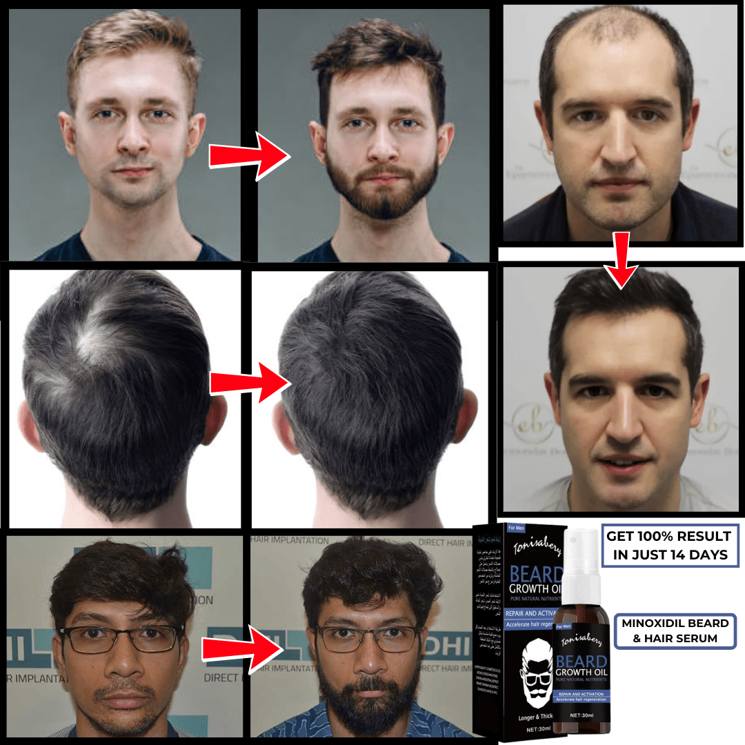 SC SHO Minoxidil 5% Beard & Hair Serum – Results in just 15 Days🔥