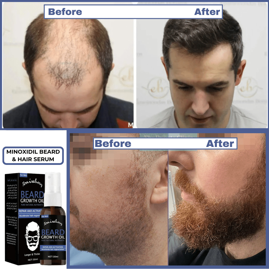 SC SHO Minoxidil 5% Beard & Hair Serum – Results in just 15 Days🔥