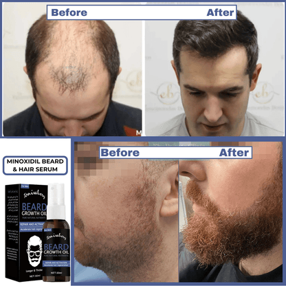 SC SHO Minoxidil 5% Beard & Hair Serum – Results in just 15 Days🔥