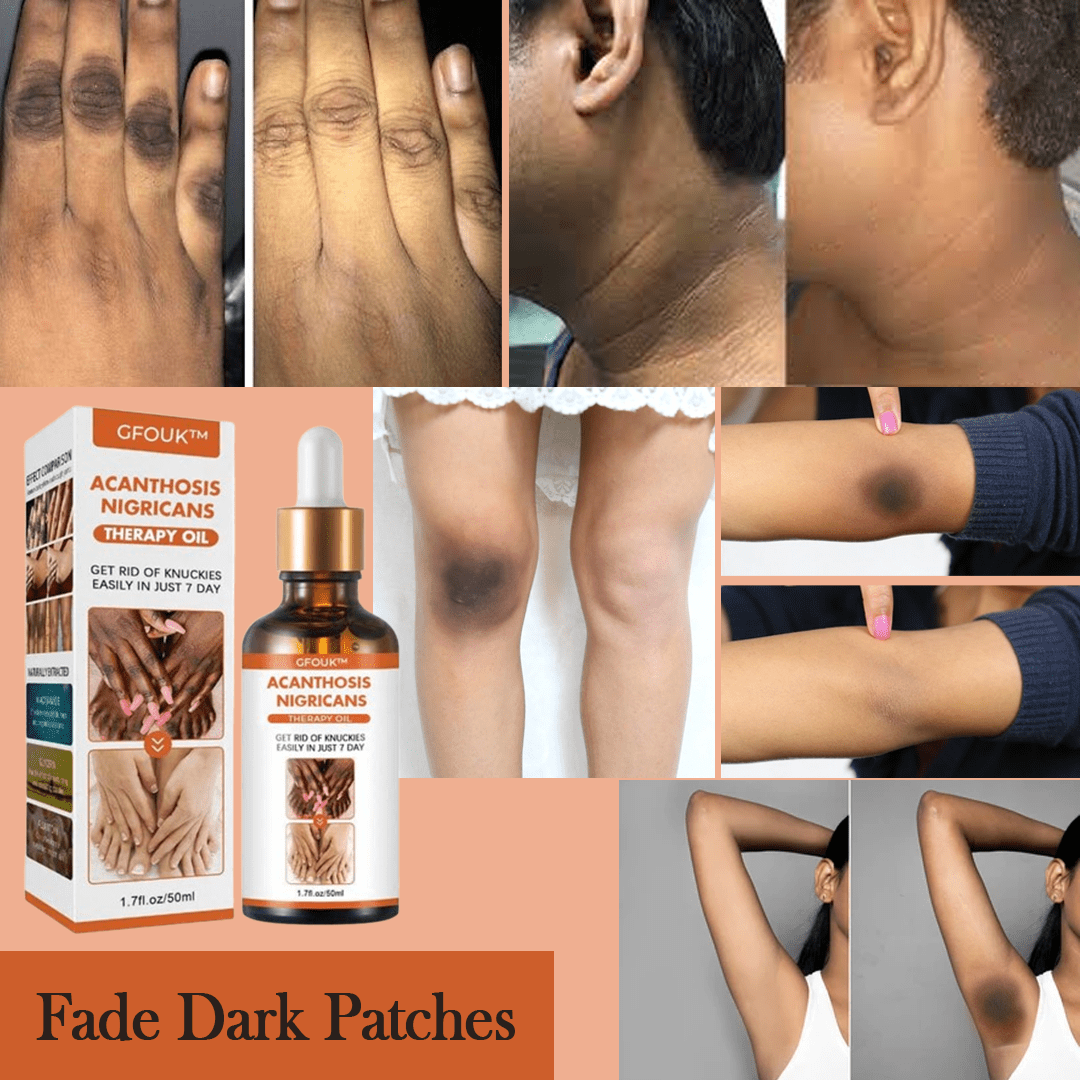 SC SHO Acanthosis Nigricans Oil – Fade Dark Patches, results in 14 days 🌟