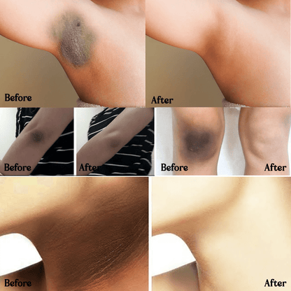 SC SHO Acanthosis Nigricans Oil – Fade Dark Patches, results in 14 days 🌟