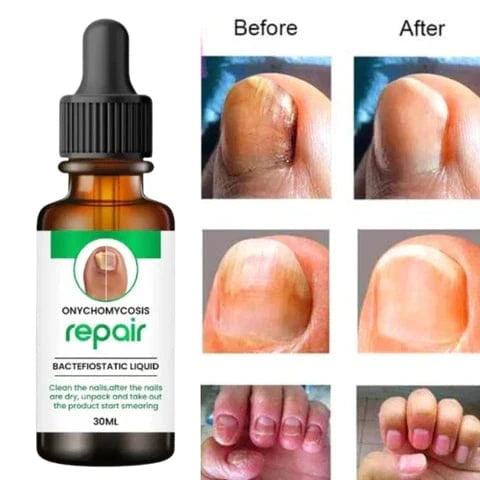 SS All In One Nail Serum 🔥 All Doctors 1st Choice 🔥(Buy 1 Get 1 Free)
