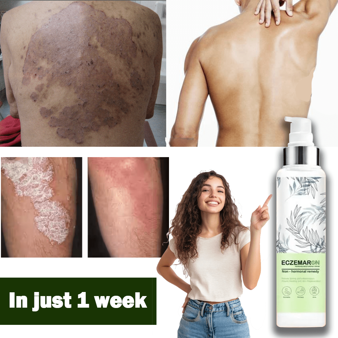 Ecze+ Anti Fungal Spray - Doctor's Recommended 👨🏽‍⚕️ Buy 1 Get 1 Free