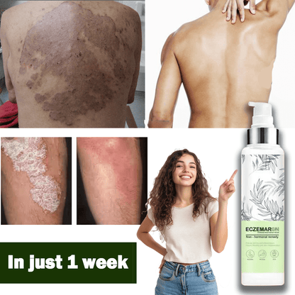 Ecze+ Anti Fungal Spray - Doctor's Recommended 👨🏽‍⚕️ Buy 1 Get 1 Free