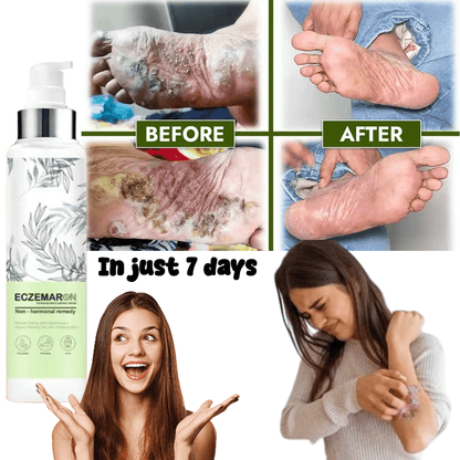 Ecze+ Anti Fungal Spray - Doctor's Recommended 👨🏽‍⚕️ Buy 1 Get 1 Free