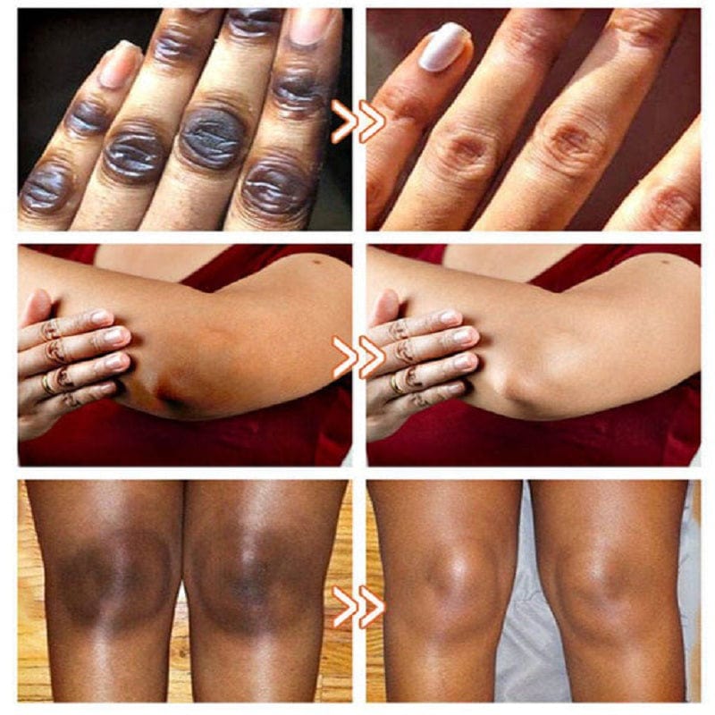 SC SHO Acanthosis Nigricans Oil – Fade Dark Patches, results in 14 days 🌟