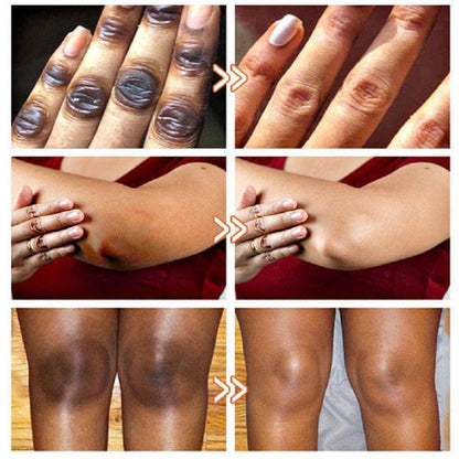 SC SHO Acanthosis Nigricans Oil – Fade Dark Patches, results in 14 days 🌟