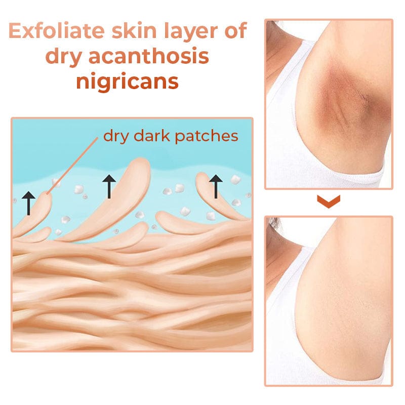 SC SHO Acanthosis Nigricans Oil – Fade Dark Patches, results in 14 days 🌟