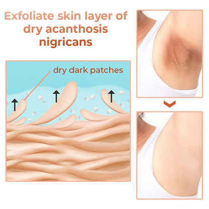SC SHO Acanthosis Nigricans Oil – Fade Dark Patches, results in 14 days 🌟