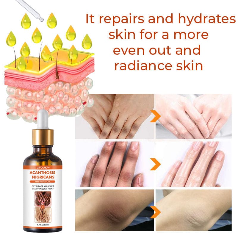 SC SHO Acanthosis Nigricans Oil – Fade Dark Patches, results in 14 days 🌟