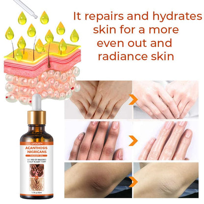 SC SHO Acanthosis Nigricans Oil – Fade Dark Patches, results in 14 days 🌟